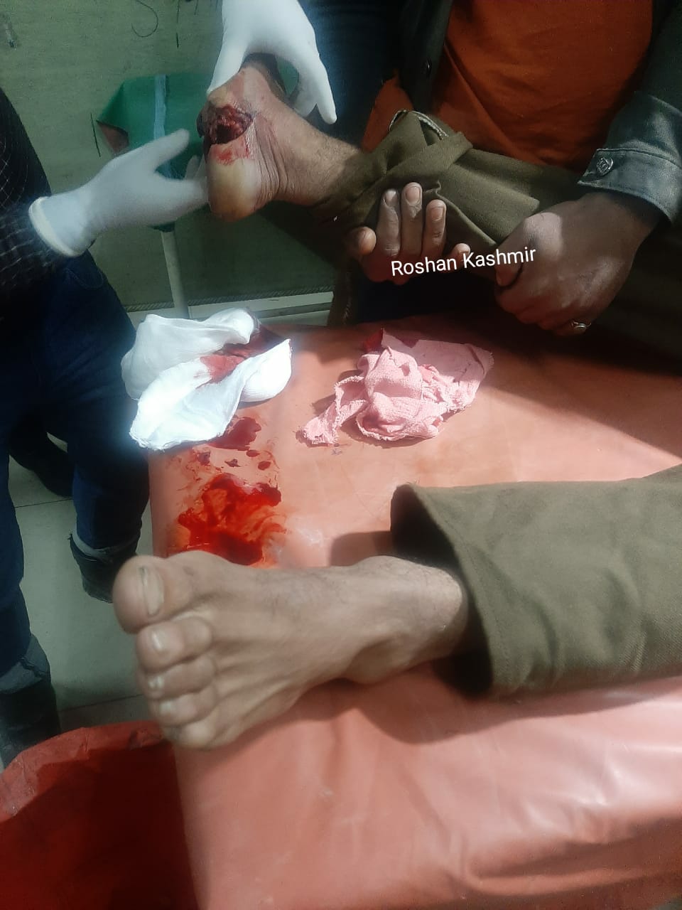 Landmine Blast Leaves Potter Injured